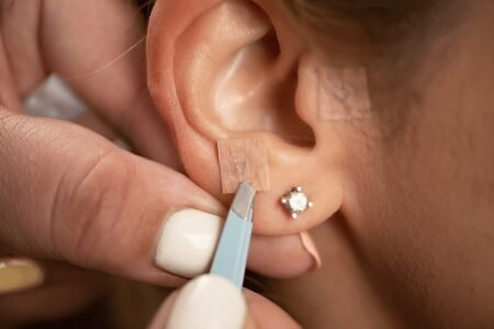 Auriculotherapy stimulates pressure points on the ear